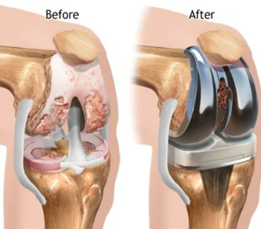 Joint-Replacement