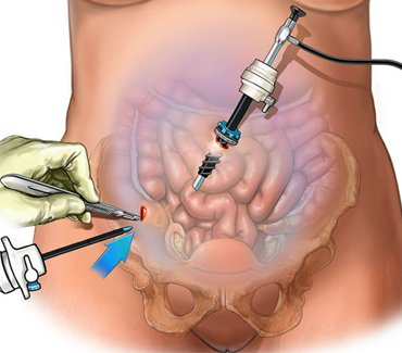 laparoscopic-surgery