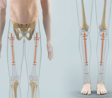 Stature-Limb-Lengthening