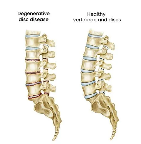 Degenerative disc disease illustration — TEMP IMAGE, replace with real photo/graphic