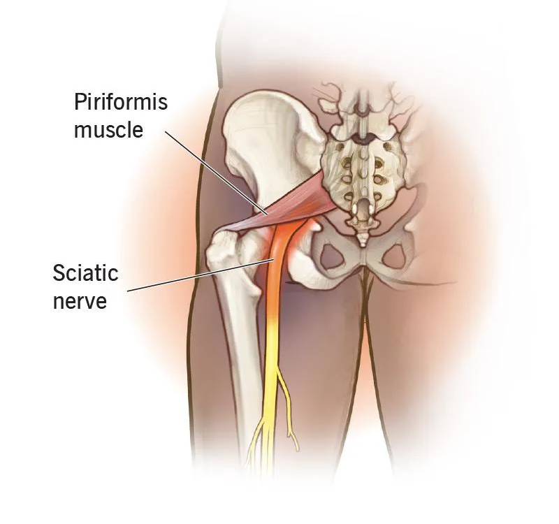 Piriformis syndrome illustration — TEMP IMAGE, replace with real photo/graphic