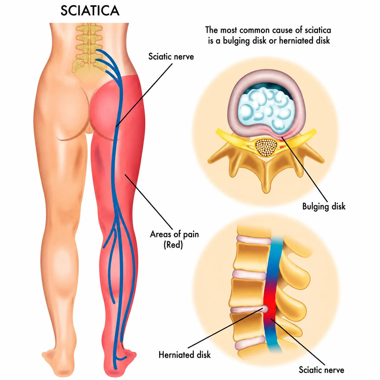 Doctor examining a patient's lower back for sciatica pain at Global Healthcare India, Gurgaon