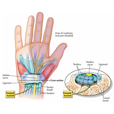 Carpal Tunnel Syndrome