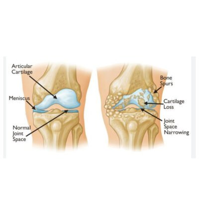 Knee Osteoarthritis