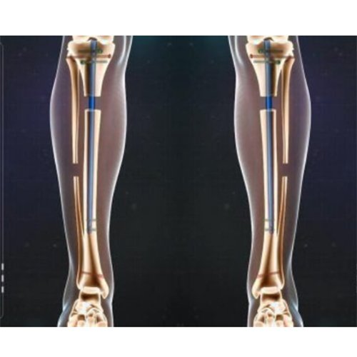 PRECISE-TIBIA