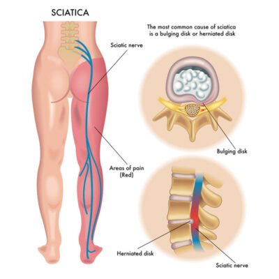 Sciatica