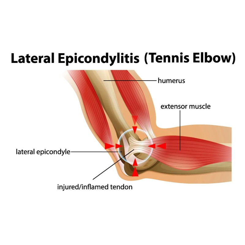 tennis elbow