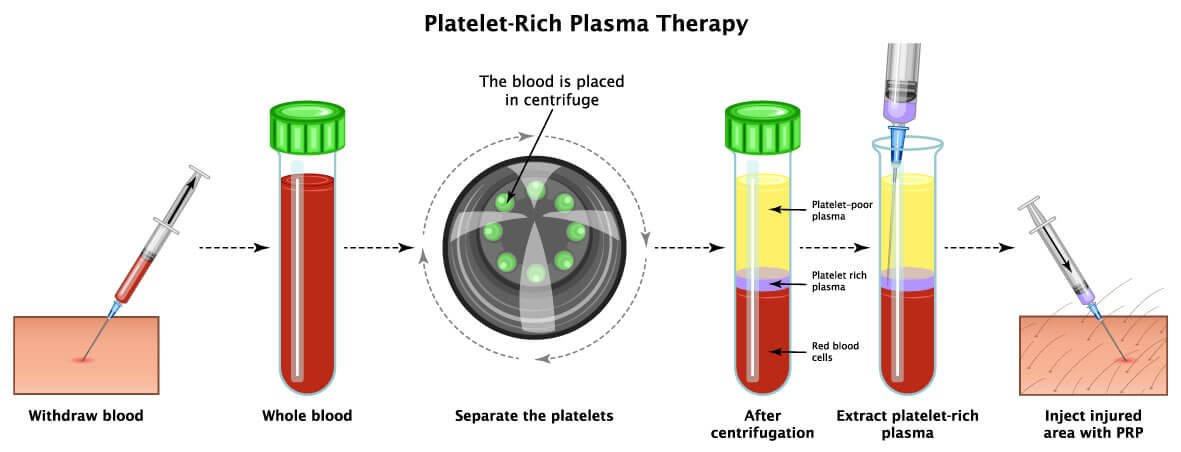 Platelet-Rich Plasma (PRP) therapy illustration