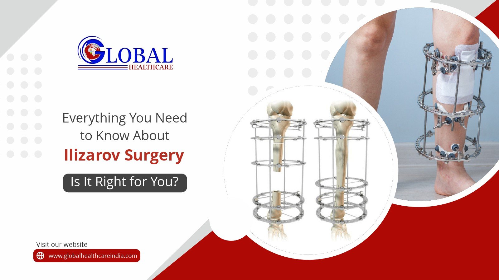 Everything You Need to Know About Ilizarov Surgery